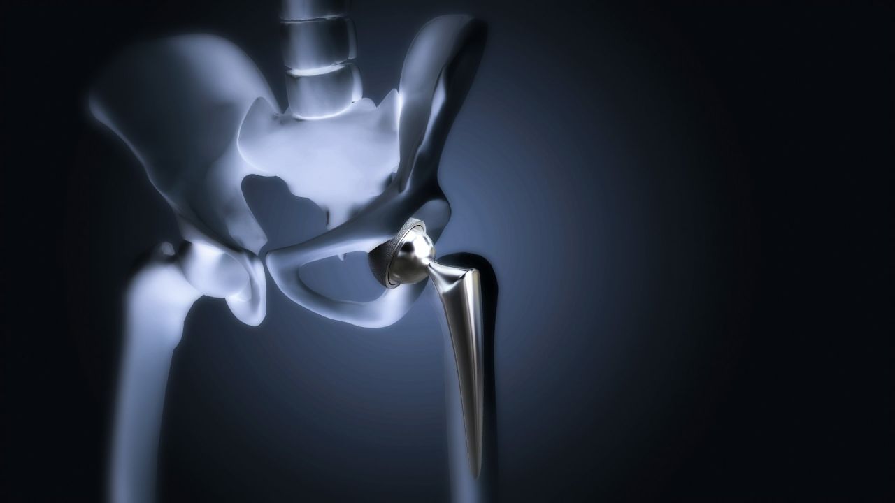 Protesi dell'anca e coxartrosi