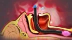COVID19: l'importanza della gestione delle complicanze laringee da intubazione endotracheale