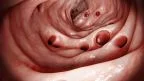 Diverticolosi e diverticolite del colon: sintomi, trattamento e prevenzione