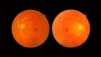 Fotobiostimolazione retinica.