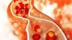 Colesterolo alto: effetti di un integratore nutraceutico