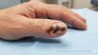 Melanoma delle unghie: come riconoscerlo, cosa fare e quando preoccuparsi
