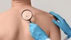 Melanoma: sintomi, cause, cura e prevenzione