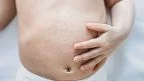 Rosolia: sintomi, prevenzione e rischi in gravidanza