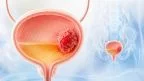 Tumore alla vescica: cos'è, sintomi, cause, diagnosi e cure