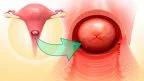 Tumore del collo dell'utero e Papilloma virus (HPV): diagnosi e prevenzione