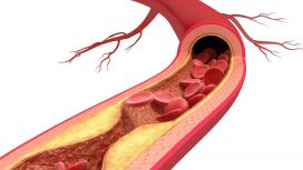 aterosclerosi colesterolo ldl