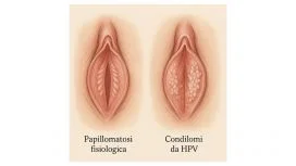Escrescenze vaginali: differenza tra papillomatosi e condilomi