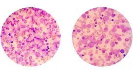 leucemia leucemia mieloide acuta tipologie