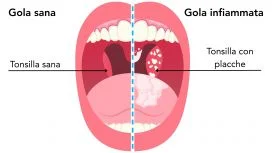 Esempio di gola sana e gola con placche