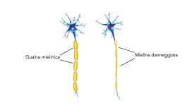 sclerosi multipla mielina danneggiata