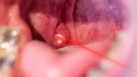 Rimozione laser dei tonsilloliti