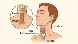 tracheo Tracheotomia procedura