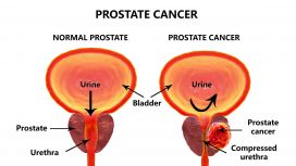 Tumore alla prostata