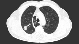 Tumore al polmone 