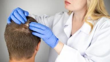 Alopecia areata: fattori d'insorgenza e comorbidità