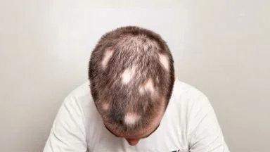 Testa di uomo con alopecia areata