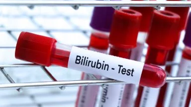 Bilirubina: cos’è, valori normali e quando preoccuparsi