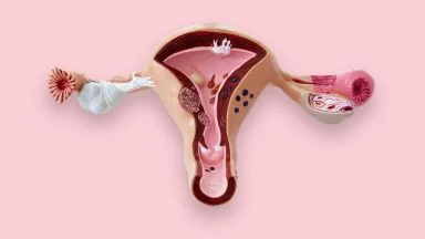 Ectopia utero.