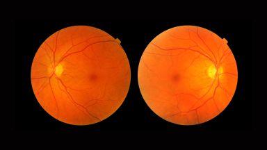 Fotobiostimolazione retinica