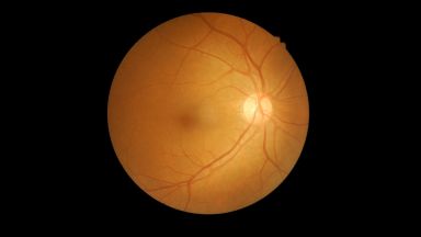 Glaucoma sintomi rischi