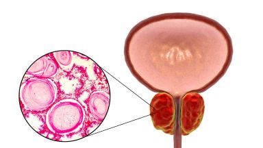 ipertrofia prostatica benigna sintomi diagnosi