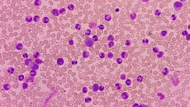 Leucemia mieloide acuta.