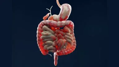 La malattia di Crohn perianale