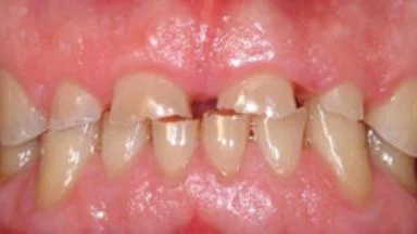 Il ruolo dell’Occlusione nella patogenesi del Bruxismo