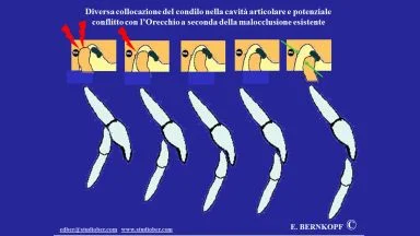 Prurito auricolare cronico.