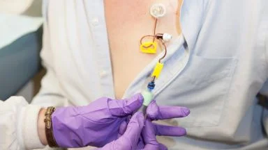 La radio-chemioterapia: due trattamenti insieme per combattere il cancro
