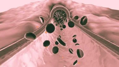 Trigliceridi alti aumentano il rischio di ictus ischemico