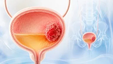 tumore alla vescica guida completa