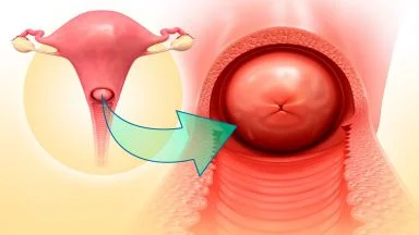 Tumore del collo dell'utero e Papilloma virus (HPV): diagnosi e prevenzione