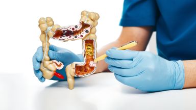 Tumore colon retto prevenzione
