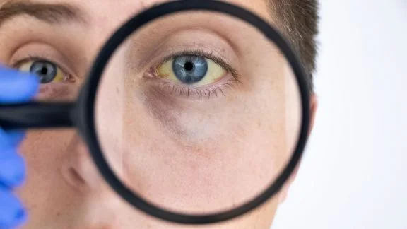 Bilirubina alta: cause, sintomi e quando preoccuparsi