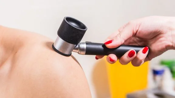 Melanoma nodulare: l'importanza della diagnosi precoce