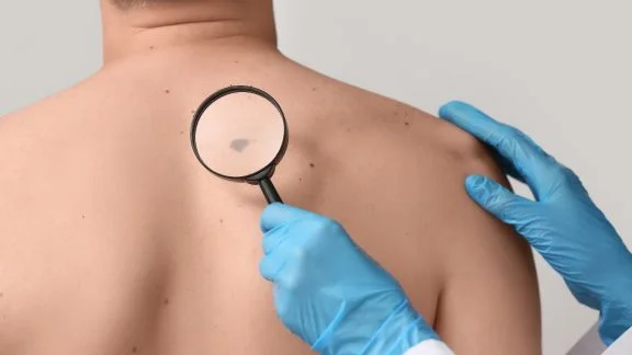 Melanoma: riconoscerlo presto può salvarti la vita