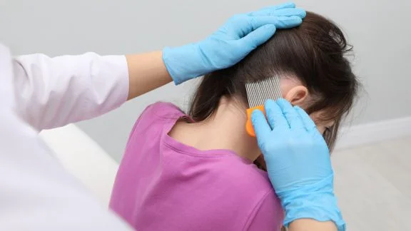 Come rimuovere i pidocchi?