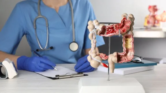 Il polipo maligno (cancerizzato) del colon