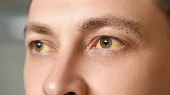 Sindrome di gilbert occhi gialli.