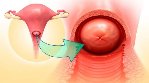 Gennaio mese della sensibilizzazione del cancro alla cervice