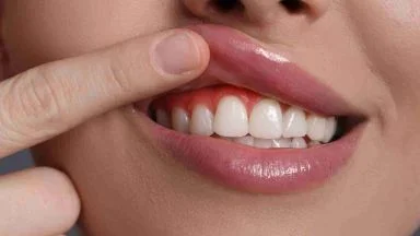 Non ignorare le tue gengive: ti basta una mela per prevenire danni seri