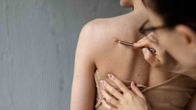 Non lo sa nessuno ma se un neo è di questo colore devi correre dal medico: rischi grosso ma te ne accorgi tardi