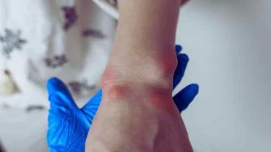 Tempo di Primavera e di insetti: cosa fare subito in caso di puntura