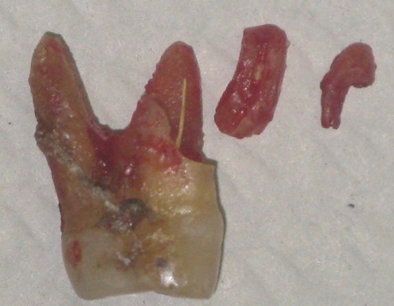 Foto del dente fratturato