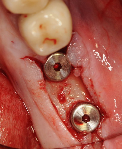 Lembo tradizionale in intervento implantologico