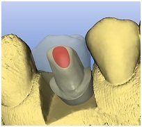 Progetto protesico virtuale
