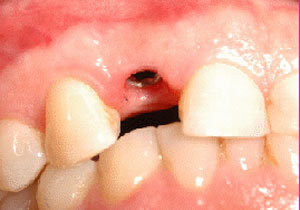 Impianto posizionato sul dente mancante