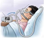 Apnee notturne: terapia con CPAP